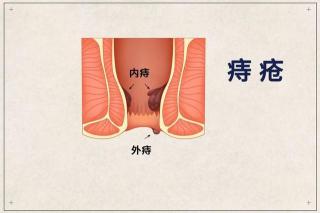 痔疮的最佳治疗方法，保守、外部处理与手术治疗