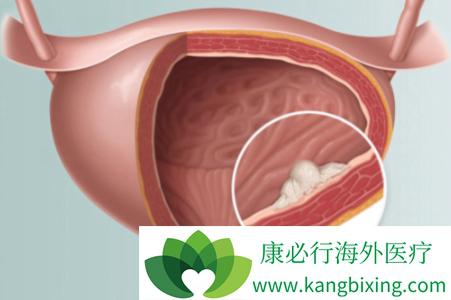 膀胱癌症状：血尿、疼痛与其他并发症的警示