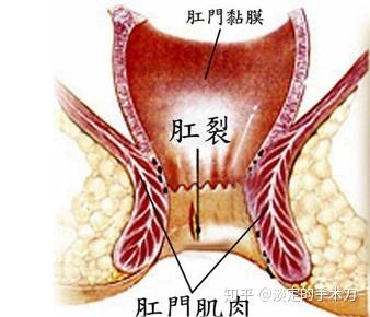 肛门滴血：可能的病因及应对方法