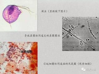 霉菌性阴道炎治疗全攻略，让你轻松摆脱病痛困扰