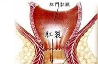 肛门滴血：可能的病因及应对方法