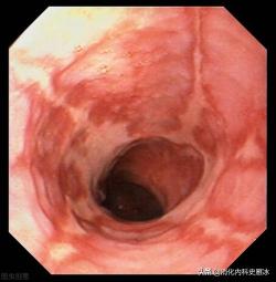 食管炎的症状及其应对方法