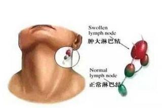 颈部淋巴结肿大：原因、诊断与治疗