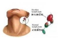 颈部淋巴结肿大：原因、诊断与治疗