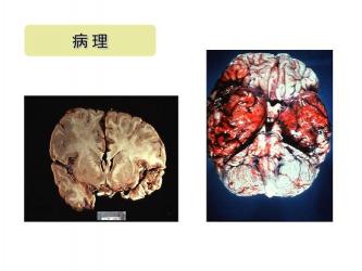 肝吸虫症状：从消化道到中枢神经系统的全面解析