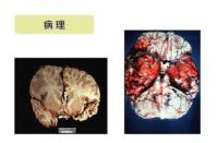 肝吸虫症状：从消化道到中枢神经系统的全面解析