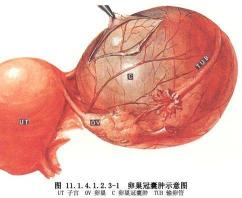 卵巢囊肿是什么原因引起的：遗传、内分泌、生活方式和环境因素的复杂交织