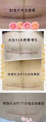 剖腹产的疤痕：形成、护理与恢复