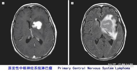 恶性淋巴瘤：严重性疾病的治疗与生存期延长