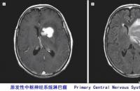 恶性淋巴瘤：严重性疾病的治疗与生存期延长