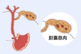 胆囊息肉怎么治疗最好？专家推荐这三种方法