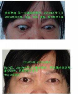 甲亢突眼：治疗方法与应对策略