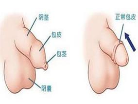 包皮手术：解决包皮过长的有效方法