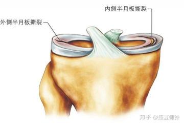 半月板损伤：了解、预防与治疗