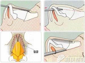 驼峰鼻整形手术：费用、影响因素及术后护理