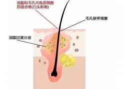 脸上长痤疮的原因：从雄激素分泌到毛囊角化，全面解析