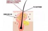 脸上长痤疮的原因：从雄激素分泌到毛囊角化，全面解析