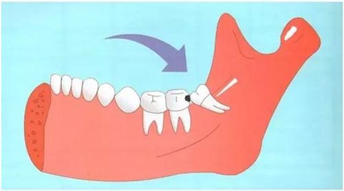 探究磨牙成因：从牙齿、心理到全身健康，揭秘为什么会磨牙