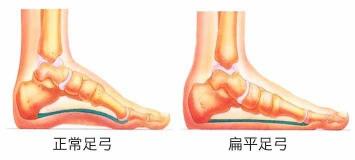 扁平足的危害：不可忽视的健康隐患