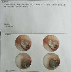 耳膜穿孔怎么办：应对方法与治疗方案