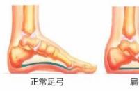 扁平足的危害：不可忽视的健康隐患