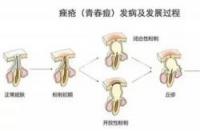 痤疮（青春痘）：定义、病因与治疗方法