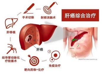 治疗肝癌的实用偏方：缓解疼痛的有效方法