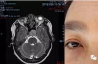 脑垂体瘤的症状：头痛、呕吐和视力障碍