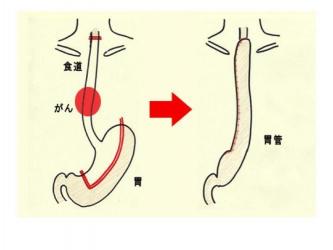 食道癌手术后：如何通过饮食调理加速康复