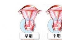 揭秘子宫癌的诱因：肥胖、不育不孕、月经失调等风险因素