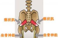 坐骨神经痛的原因：局部外伤、痛经与盆腔炎