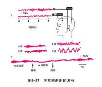 癫痫病如何诊断：从病史到脑电图的全面解析