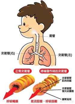 支气管炎干咳：全方位应对策略，提升生活质量