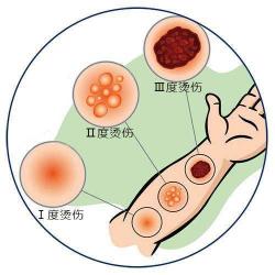 烧伤治疗：轻度、中度与重度烧伤的应对方法