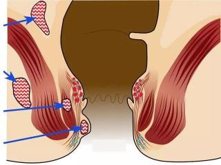 肛裂危害：常见并发症与潜在风险