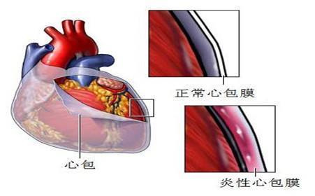 急性心包炎：认识症状与及时治疗的重要性