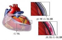 急性心包炎：认识症状与及时治疗的重要性