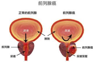 解决勃起时间不长的方法：肾虚、糖尿病与前列腺炎的应对之道