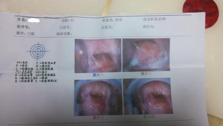 多发纳囊需要治疗吗？全面解析宫颈纳氏囊肿的治疗方法