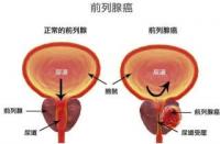 解决勃起时间不长的方法：肾虚、糖尿病与前列腺炎的应对之道