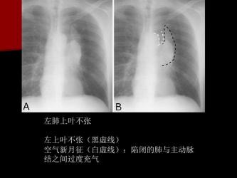 解读正常胸片：探索健康的秘密