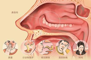 鼻炎：不会传染的常见鼻部疾病