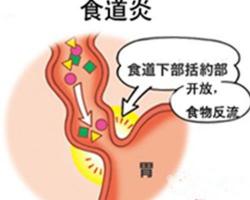 食管炎的症状：识别、影响及治疗方法