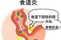 食管炎的症状：识别、影响及治疗方法