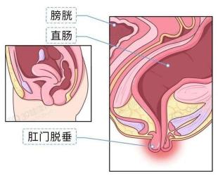 肛肠息肉揭秘：症状、原因与诊断全解析