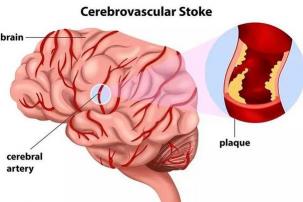 脑梗塞的症状：如何识别与应对