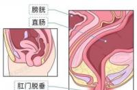 肛肠息肉揭秘：症状、原因与诊断全解析