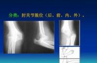 肘关节脱位：症状识别与治疗方法全解析