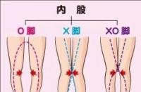 O型腿揭秘：成因、影响与防治策略