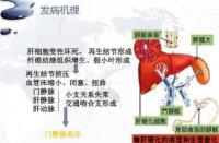 肝腹水治疗全攻略：日常护理与医学手段相结合，让康复更近一步